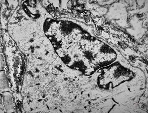 F,32y. | muscular dystrophy - regeneratiing muscle cell